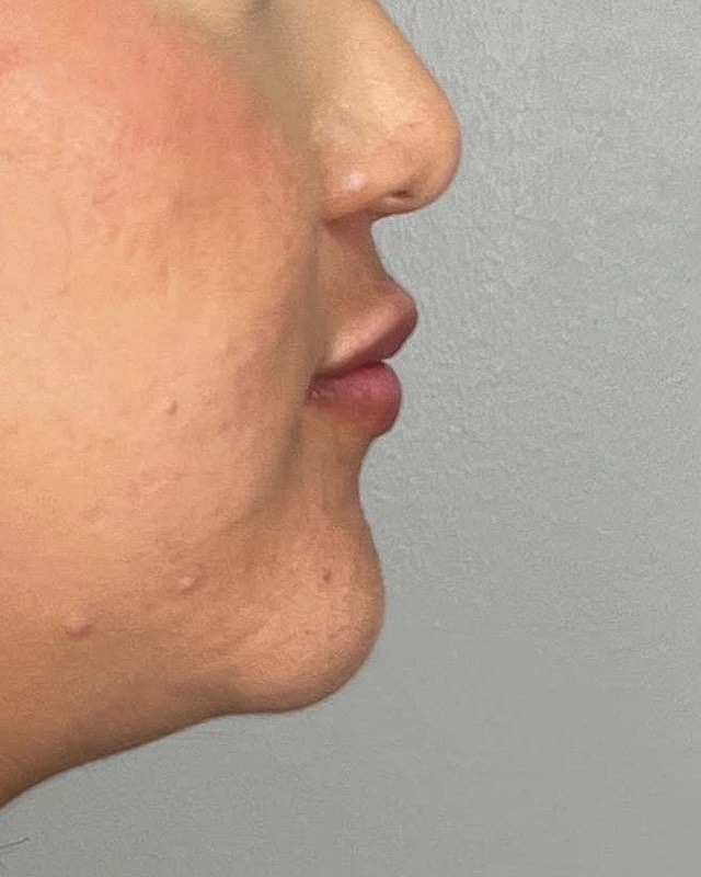 Juvederm Before & After