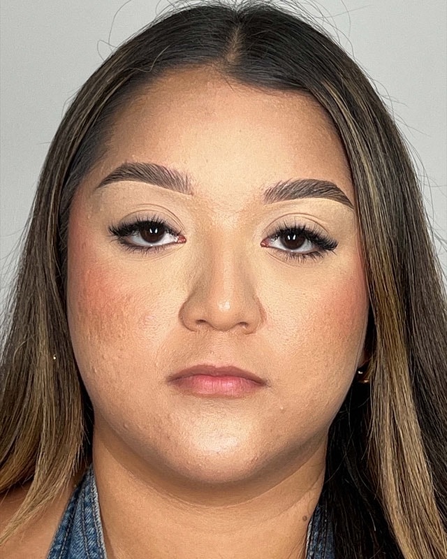 Juvederm Before & After