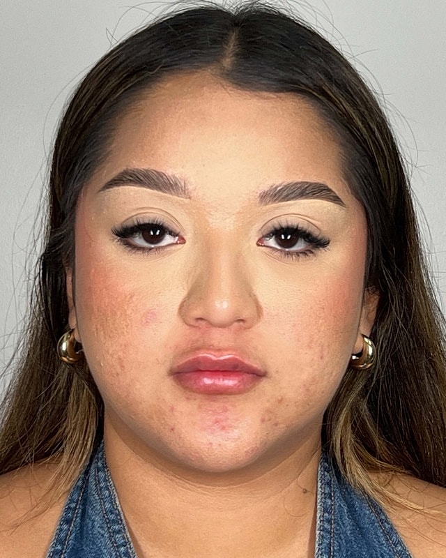 Juvederm Before & After