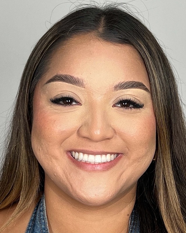 Juvederm Before & After