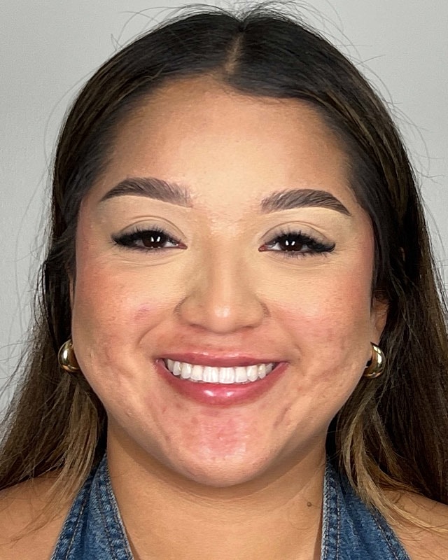Juvederm Before & After
