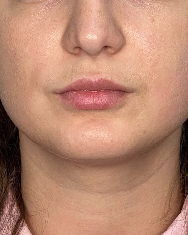 Juvederm Before & After