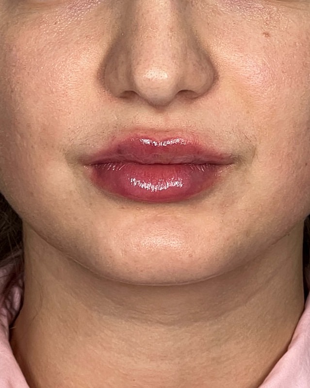 Juvederm Before & After