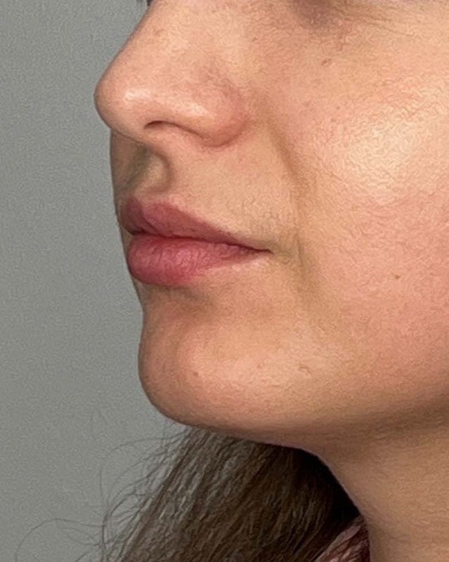 Juvederm Before & After