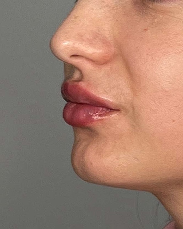 Juvederm Before & After
