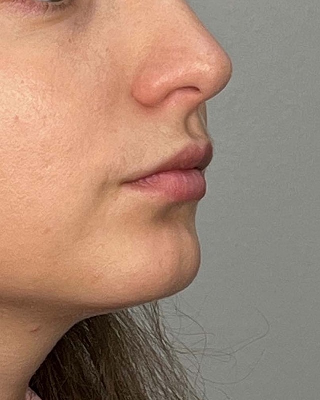 Juvederm Before & After
