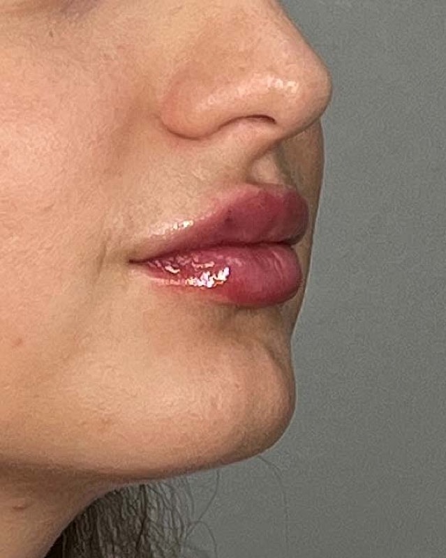 Juvederm Before & After