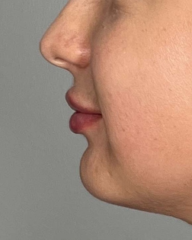 Juvederm Before & After