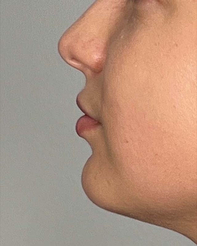 Juvederm Before & After
