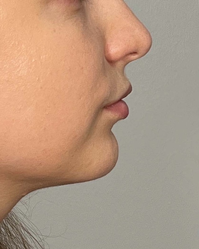 Juvederm Before & After