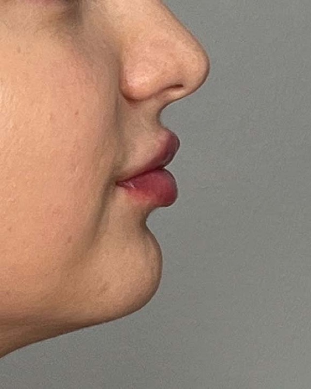 Juvederm Before & After