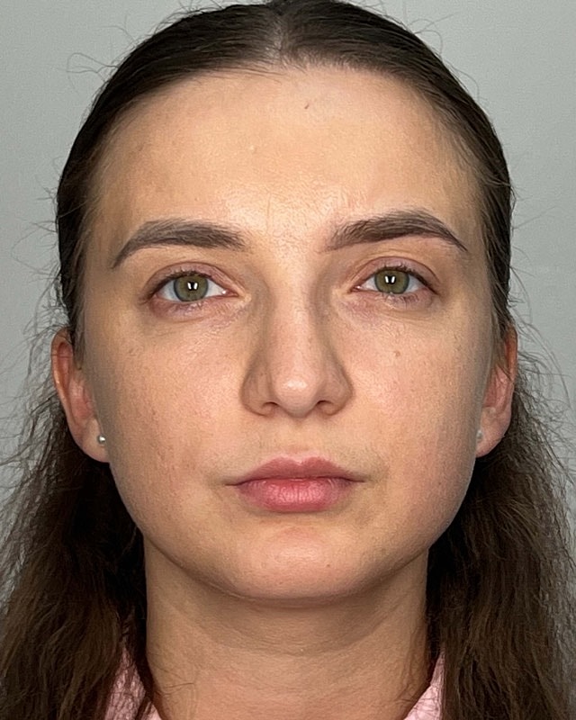 Juvederm Before & After