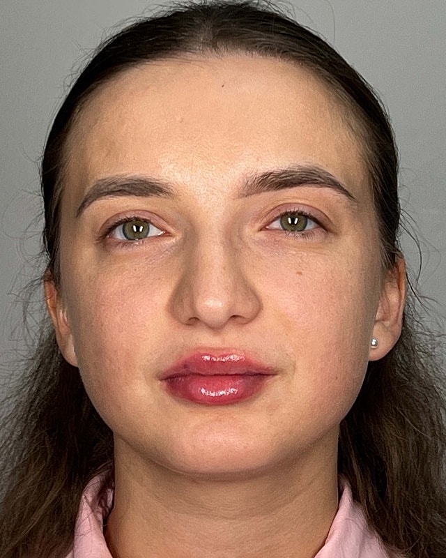 Juvederm Before & After