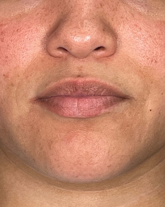 Juvederm Before & After