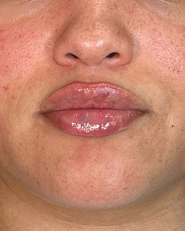 Juvederm Before & After