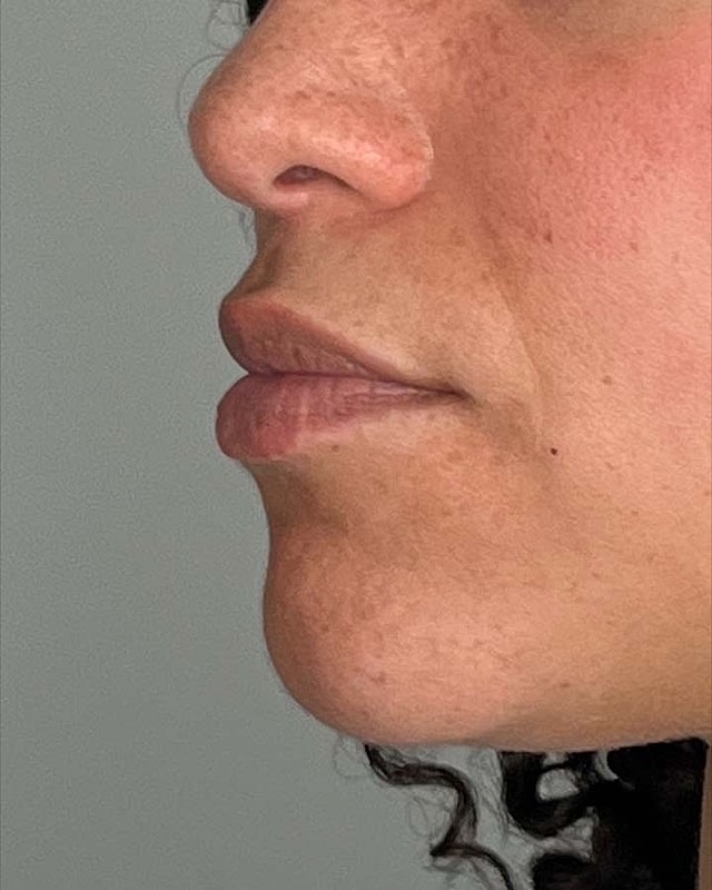 Juvederm Before & After