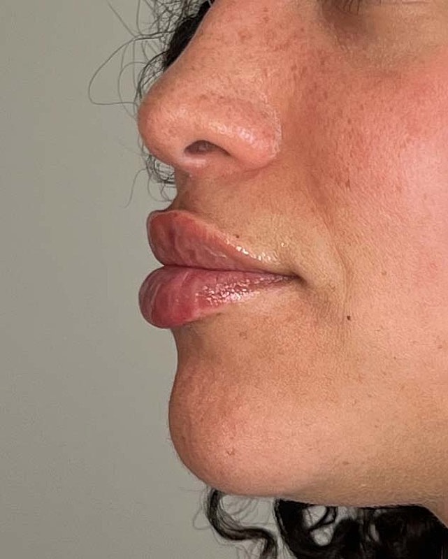 Juvederm Before & After