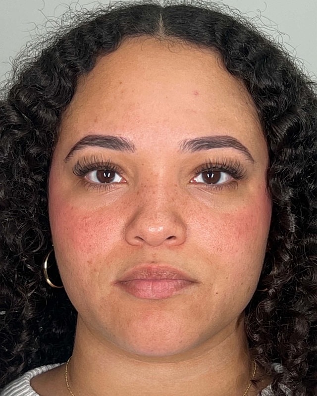 Juvederm Before & After