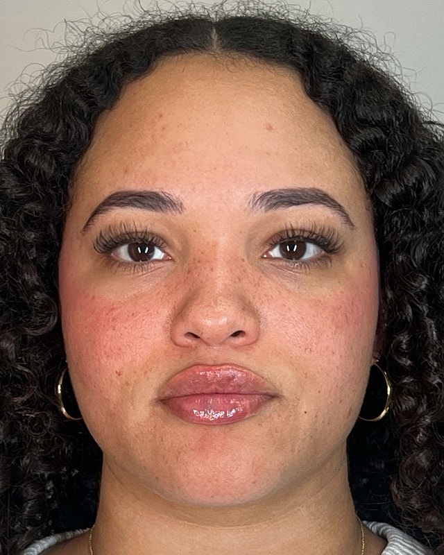 Juvederm Before & After