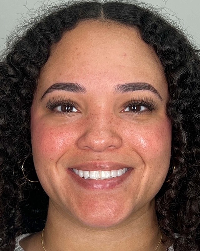 Juvederm Before & After