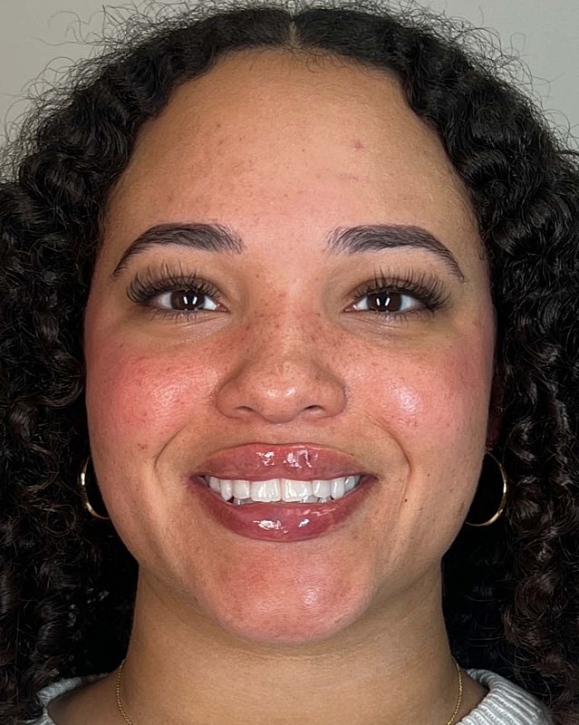 Juvederm Before & After