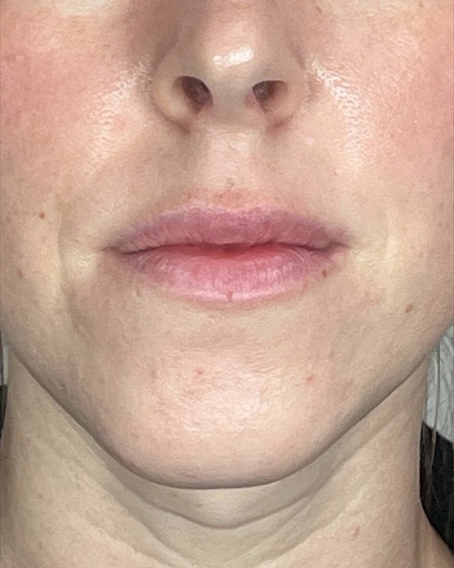 Juvederm Before & After
