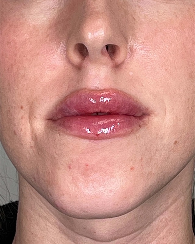 Juvederm Before & After
