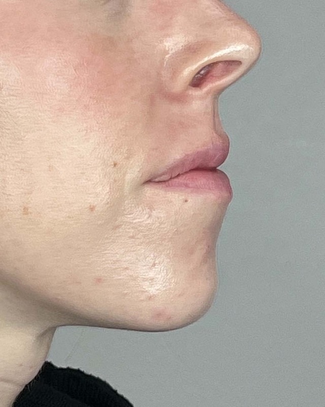 Juvederm Before & After