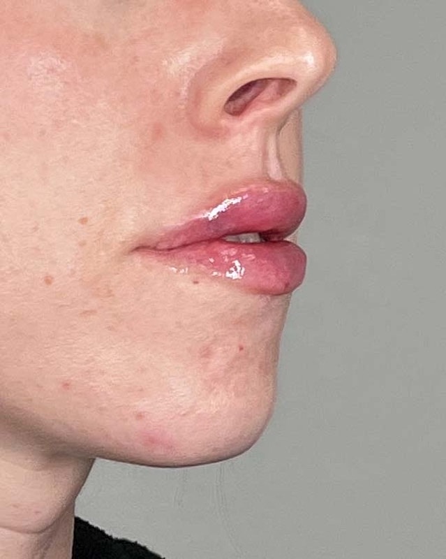 Juvederm Before & After