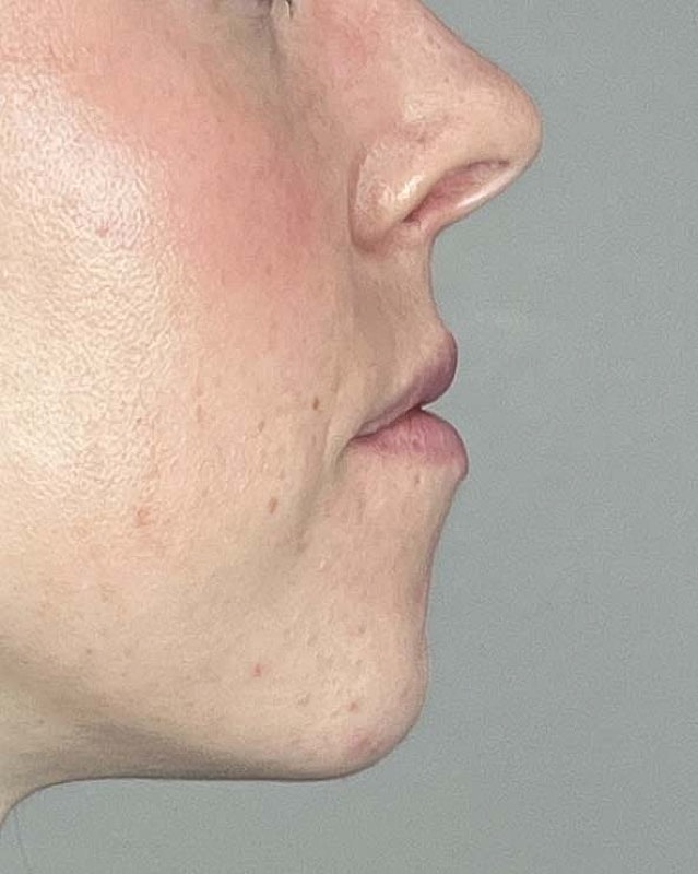 Juvederm Before & After