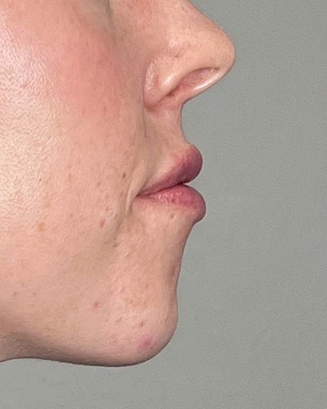 Juvederm Before & After