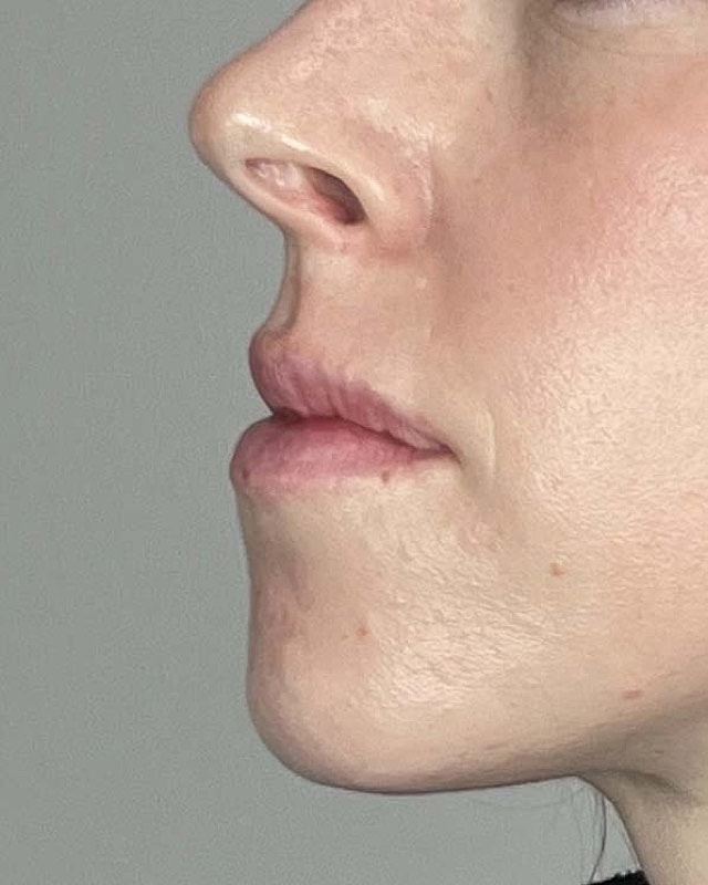 Juvederm Before & After