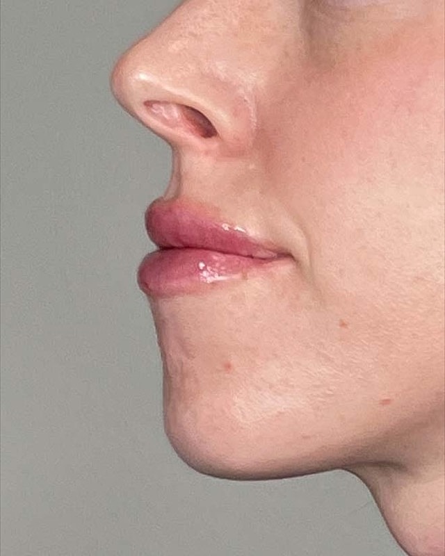 Juvederm Before & After