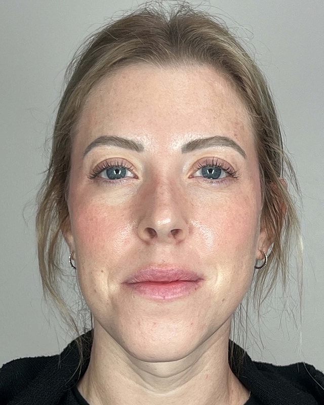 Juvederm Before & After
