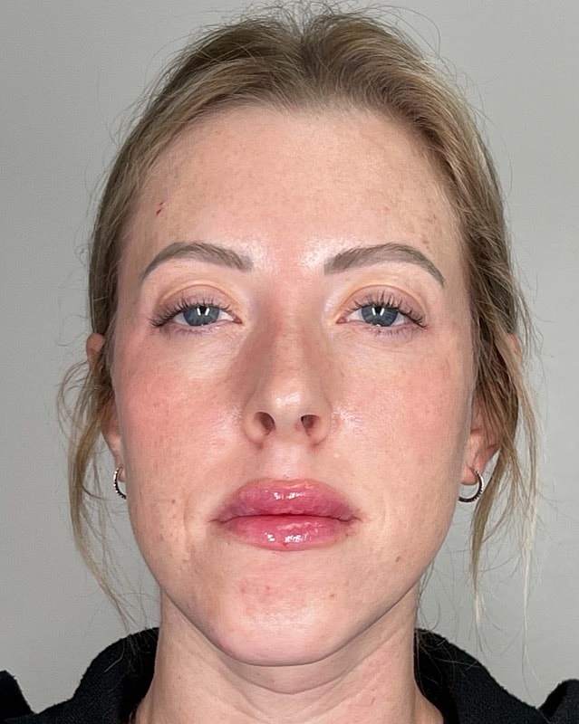 Juvederm Before & After