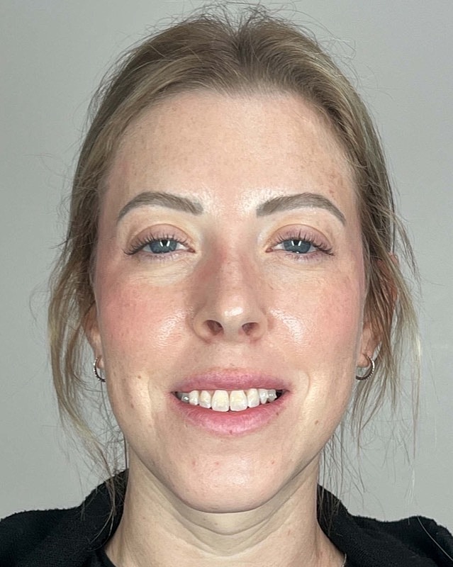Juvederm Before & After