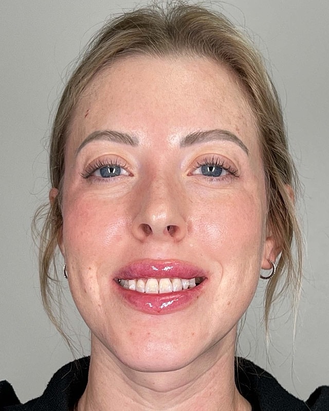 Juvederm Before & After