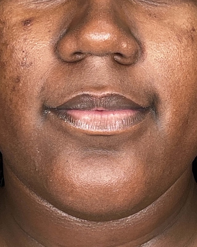 Juvederm Before & After