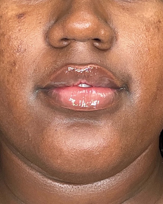 Juvederm Before & After