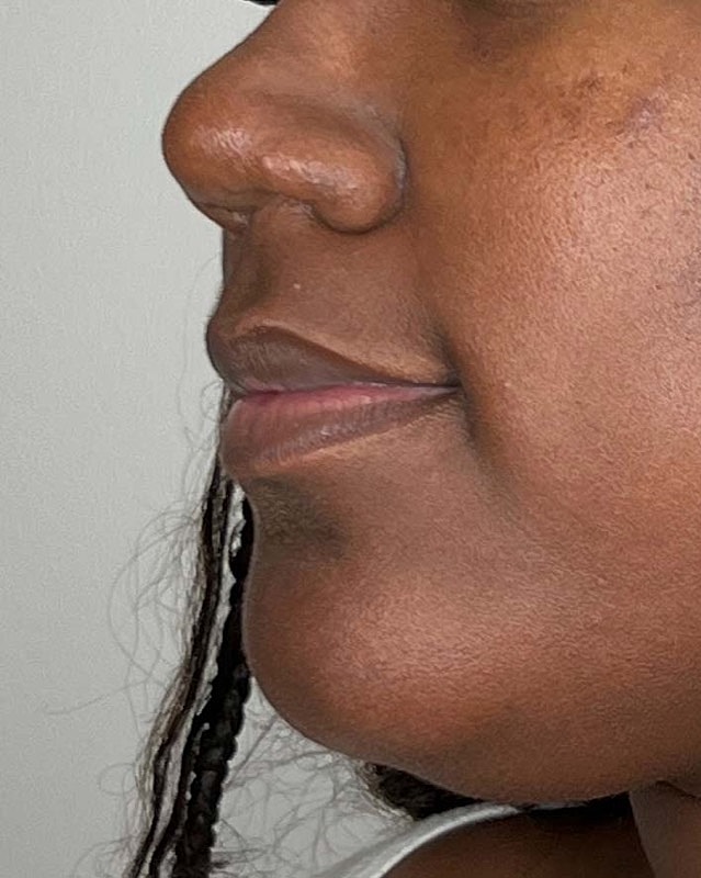 Juvederm Before & After