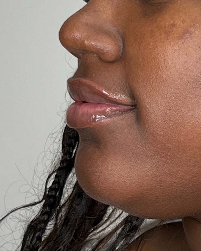 Juvederm Before & After