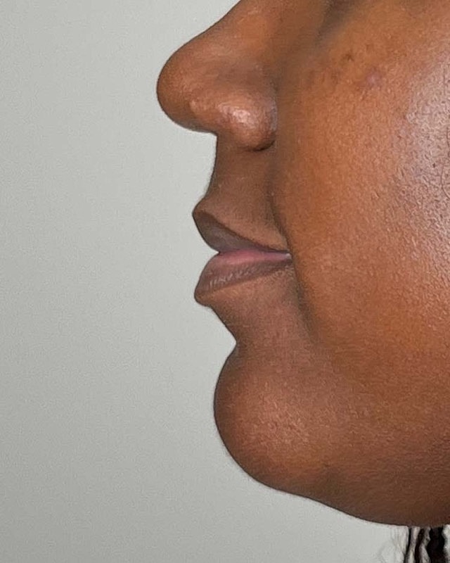 Juvederm Before & After