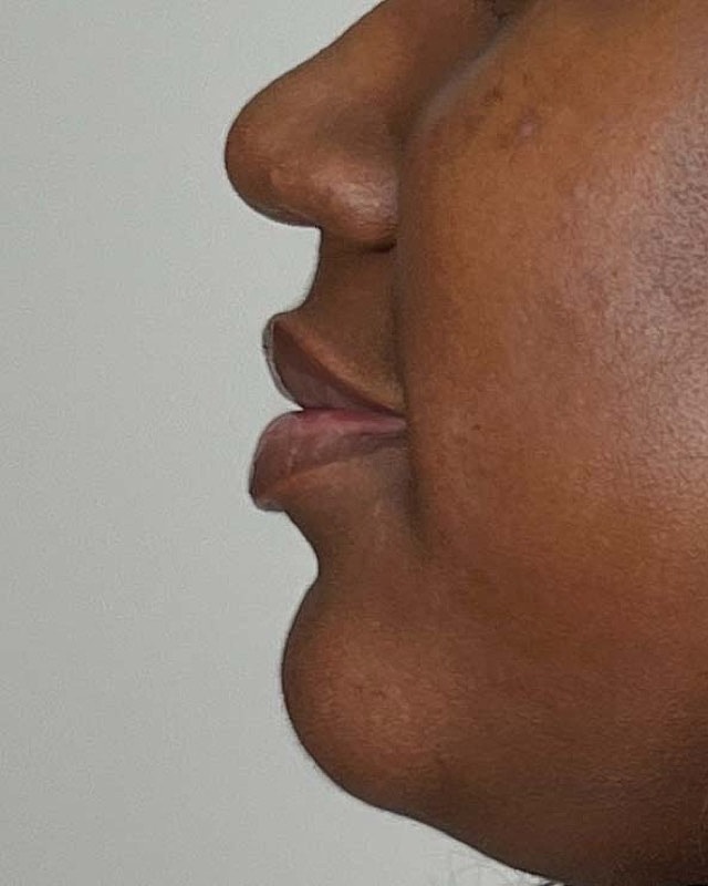 Juvederm Before & After