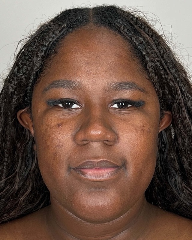 Juvederm Before & After