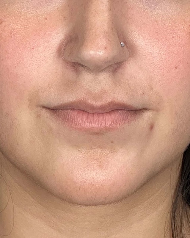 Juvederm Before & After