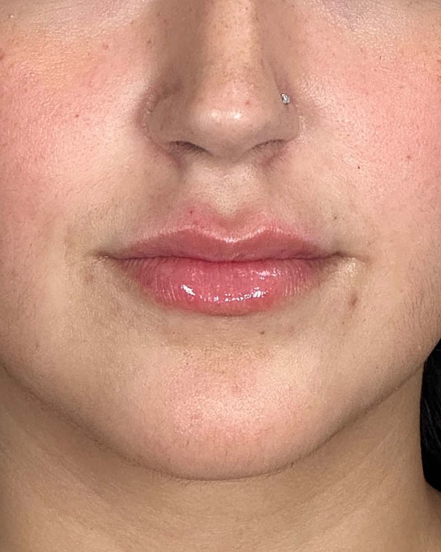 Juvederm Before & After