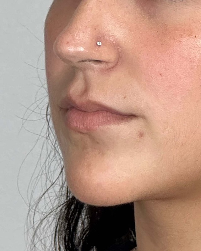 Juvederm Before & After