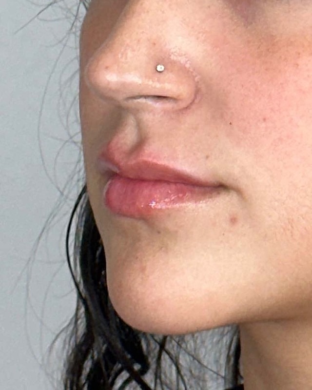 Juvederm Before & After