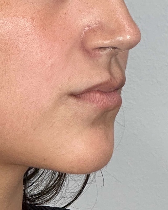 Juvederm Before & After