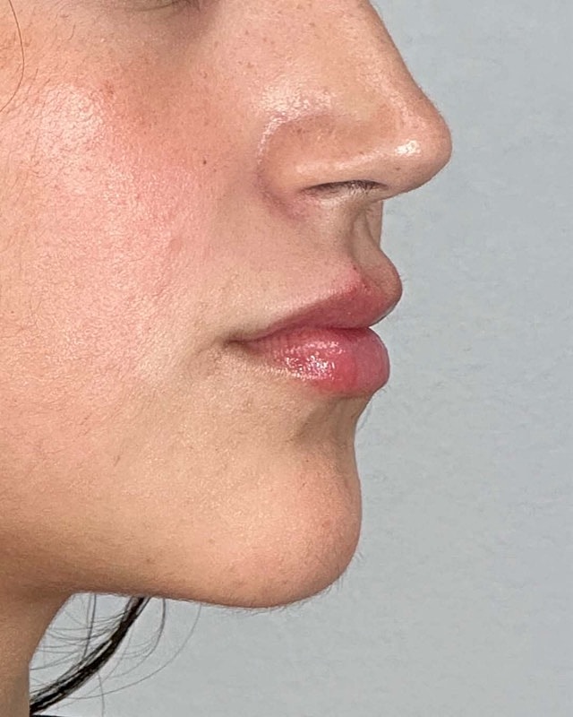 Juvederm Before & After